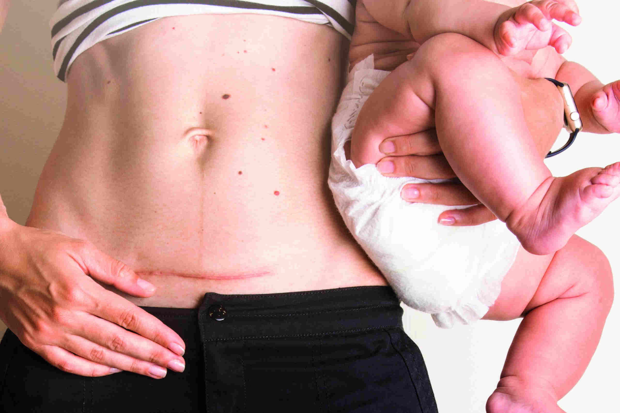 Cesáreas innecesarias