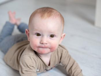 Dermatitis atópica I: la aparición en la infancia y la temida marcha atópica